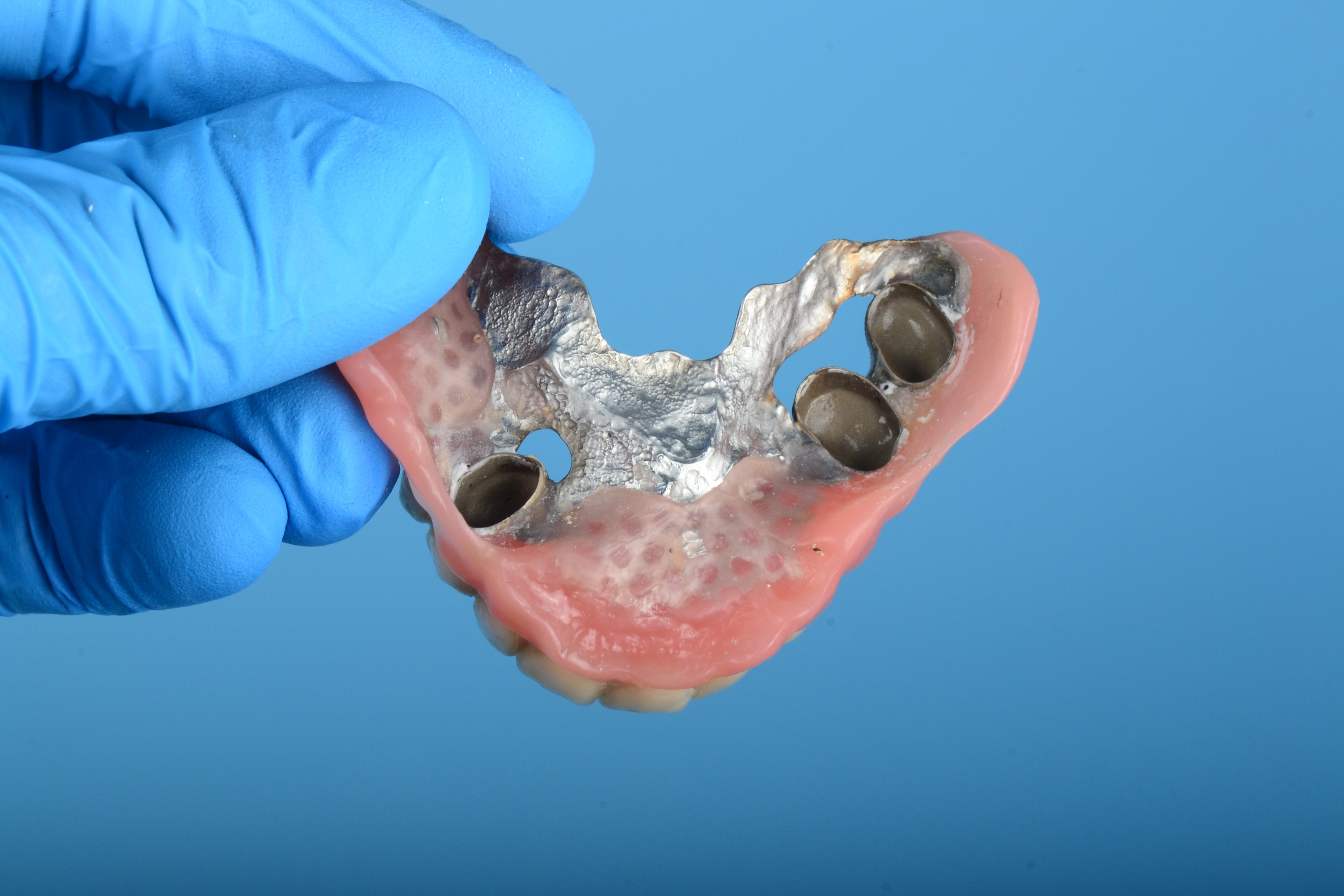 Proteza na teleskopima